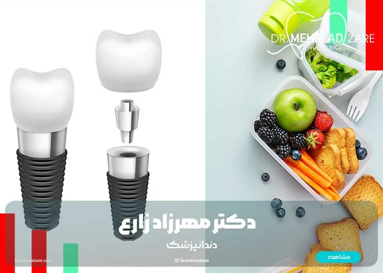 بعد از ایمپلنت دندان چه بخوریم؟