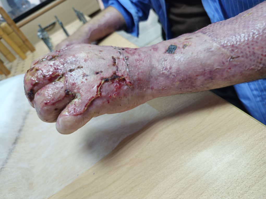 أفضل مركز متخصص لعلاج حروق اليد في طهران (المناطق 17، 18، 19، الجنوب والجنوب الغربي)، مركز سابا للعلاج الوظيفي