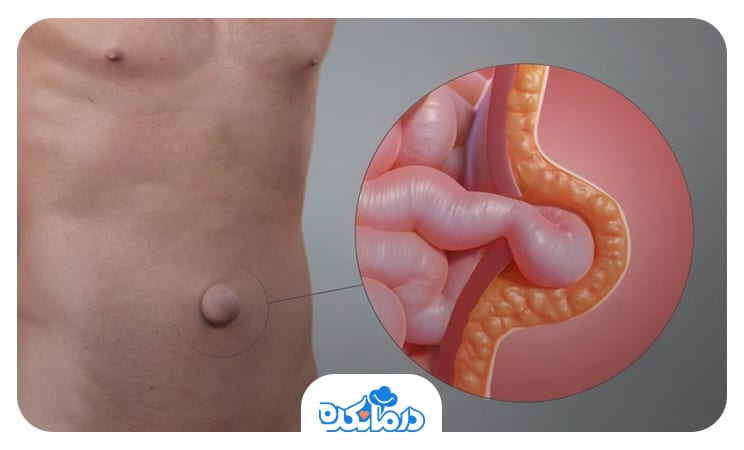 All you need to know about hernia disease