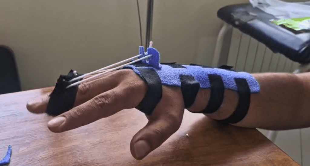 العلاج المتخصص لليد باستخدام الجبائر