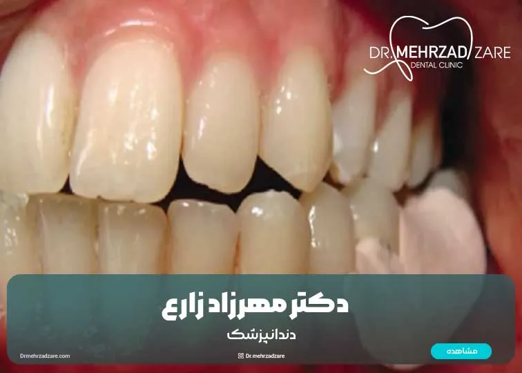 پانسمان دندان عصب کشی شده چیست و در صورت افتادن آن چه باید کرد؟