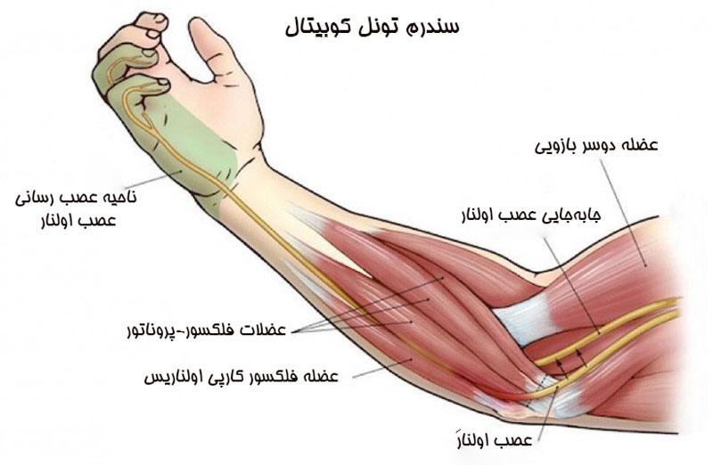 متلازمة النفق المرفقي: التشخيص والعلاج من قبل أفضل مركز للعلاج اليدوي والعلاج المهني في جنوب طهران
