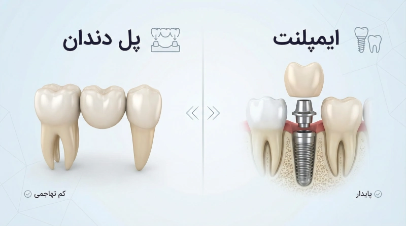 بریج دندان بهتر است یا ایمپلنت؟ مقایسه ای برای تصمیم گیری بهتر