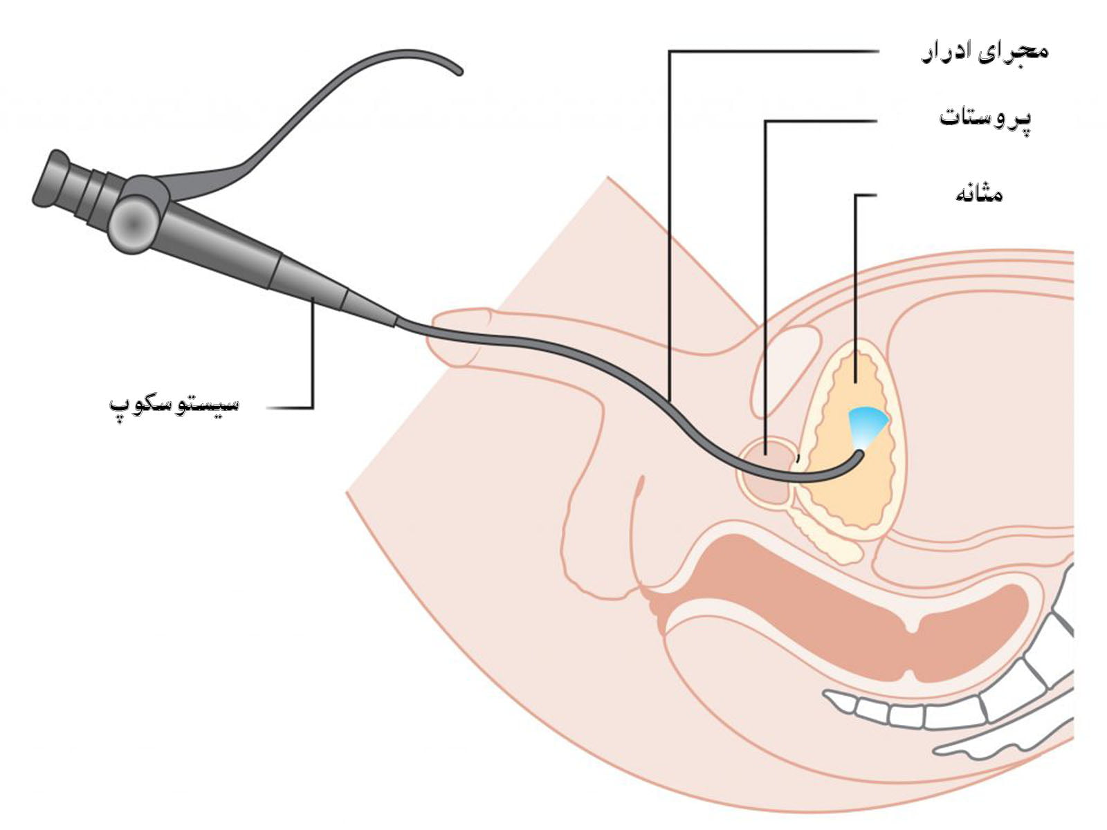 Cost of flexible cystoscopy - Jahanshahr Urology Center
