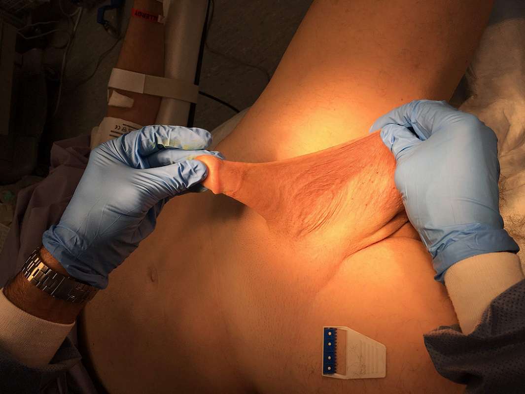 The best methods of genital reconstructive surgery - Jahanshahr Urology Center