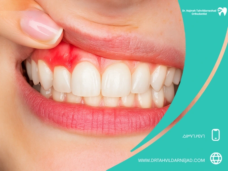 Causes of tooth pain after dental veneers