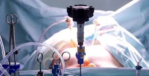 laparoscopic hysterectomy; When is it recommended?