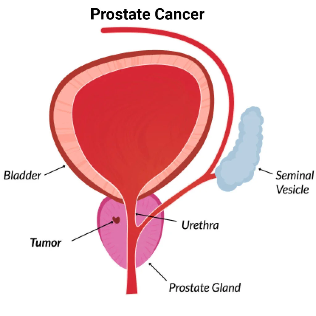 Does prostate laser hurt - Jahanshahr Urology Center