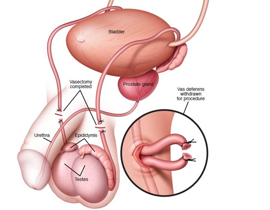 مزایای وازکتومی سرپایی - مرکز اورولوژی جهانشهر