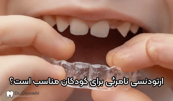 آیا ارتودنسی نامرئی برای کودکان مناسب است؟