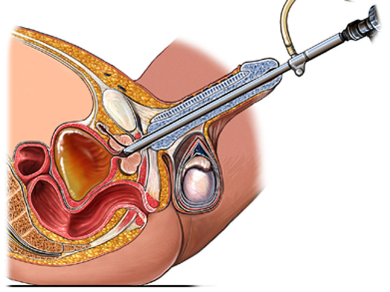 درمان اورژانسی انسداد ادراری - مرکز اورولوژی جهانشهر