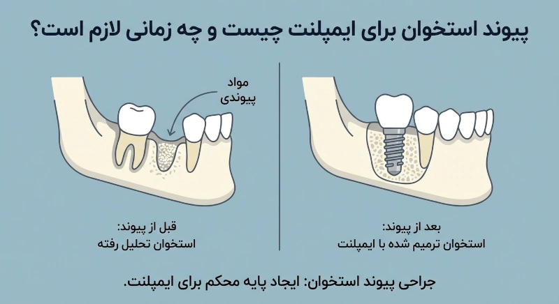 چه زمانی جراحی پیوند استخوان برای ایمپلنت ضروری است؟