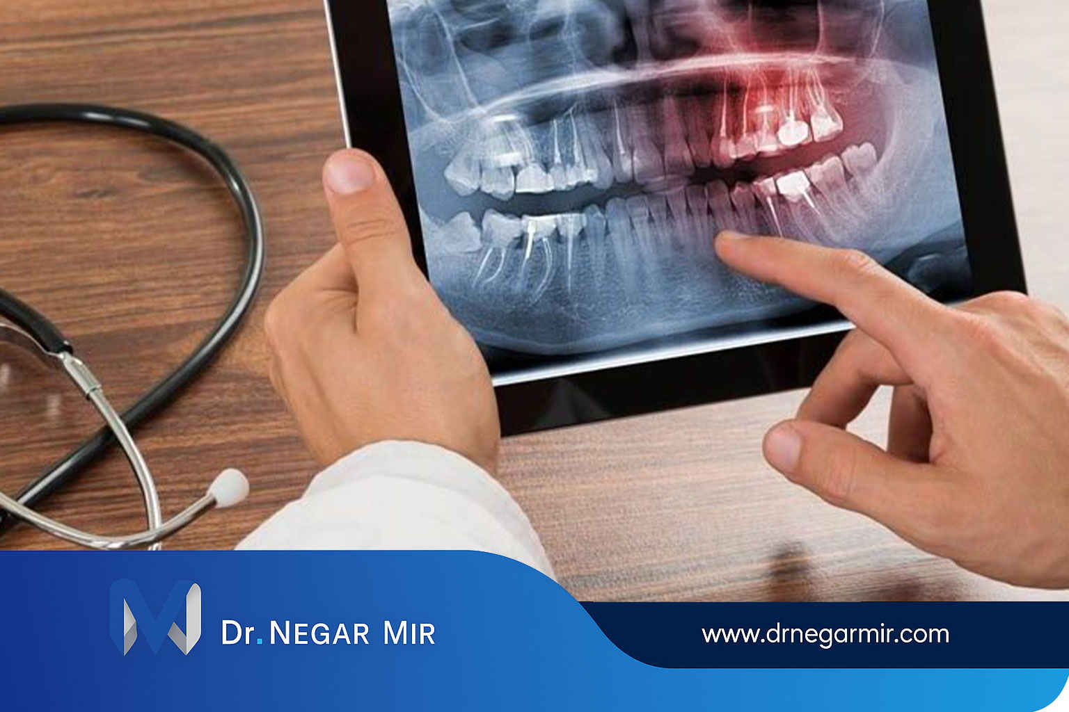 تصميم الابتسامة بالذكاء الاصطناعي؛ تجربة رؤية ابتسامة مثالية قبل العلاج 1404