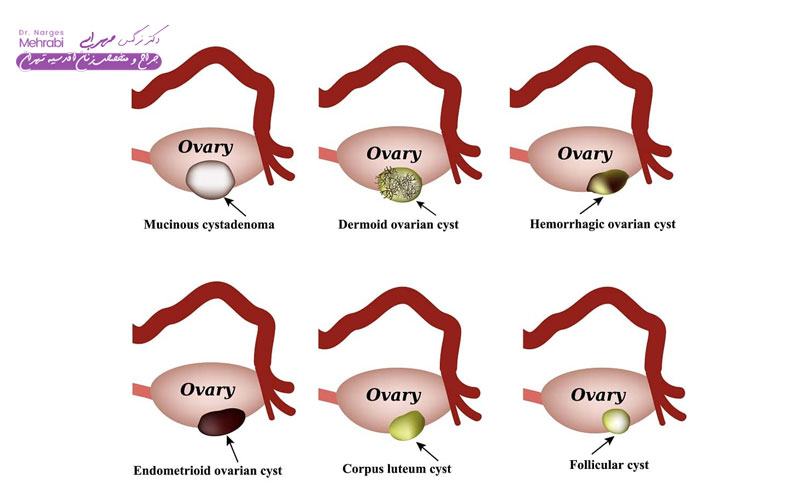 بررسی جامع انواع کیست تخمدان دکتر نرگس محرابی