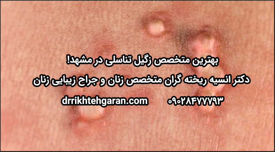 بهترین متخصص زگیل تناسلی در مشهد درمان تخصصی HPV با "دکتر خادگران"