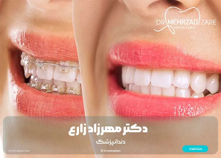 The difference between orthodontics and laminate to correct teeth