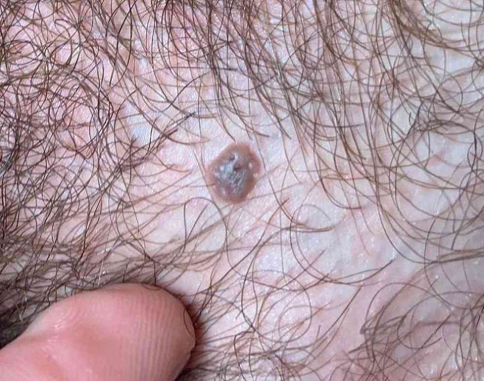 Treatment of genital warts