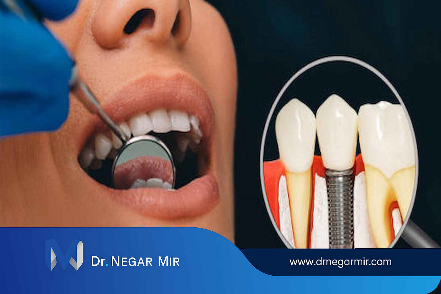 زرع ليوم واحد، زرع تحميل فوري (تحميل فوري