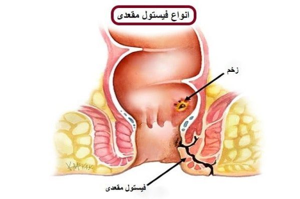 الناسور الشرجي وعلاجه - دكتور كرامتي أخصائي جراحة القولون والمستقيم