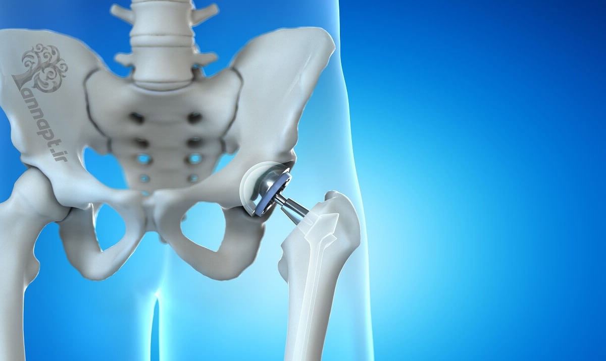 كل ما تريد معرفته عن العلاج الطبيعي المتخصص لمفصل الورك!