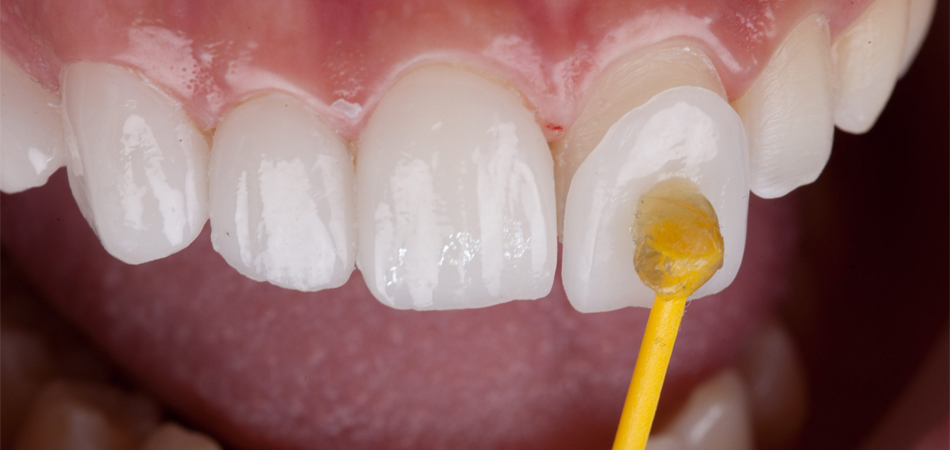 What is crystal laminate and how is it different from ordinary and composite laminate?