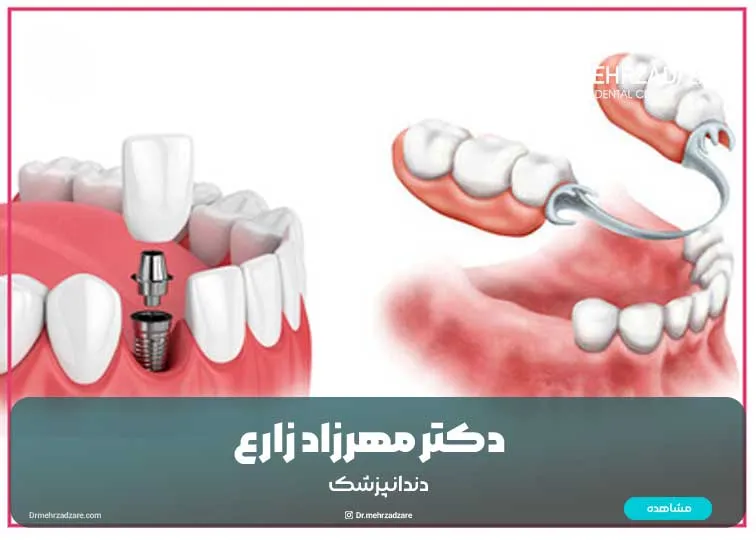 Is dental implant better or dental prosthesis?