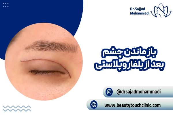 باز ماندن چشم پس از بلفاروپلاستی علل، علائم و راه حل های درمان