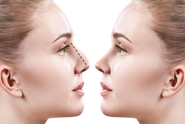 جراحی بینی کج