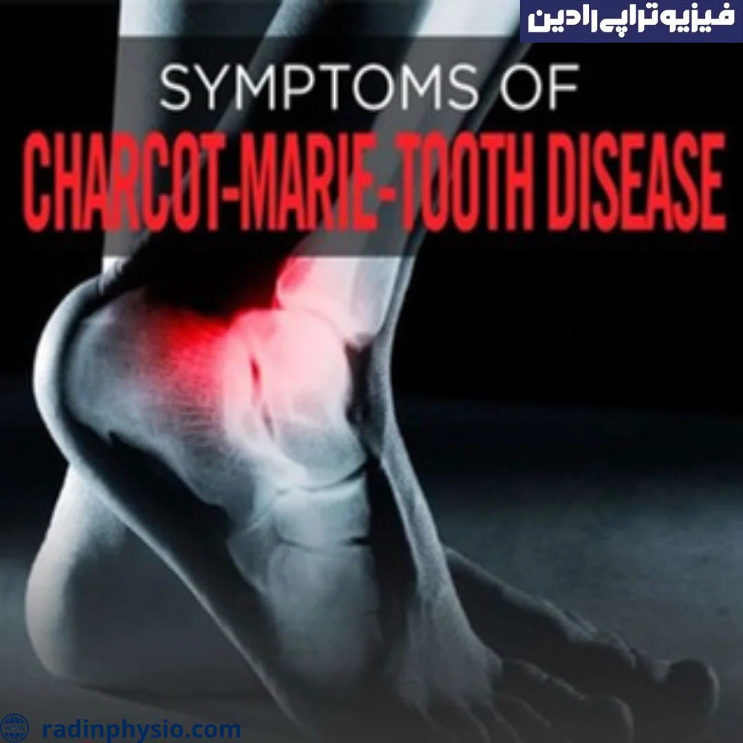فیزیوتراپی بیماری شارکو ماری توث چگونه است؟ کلینیک فیزیوتراپی رادین