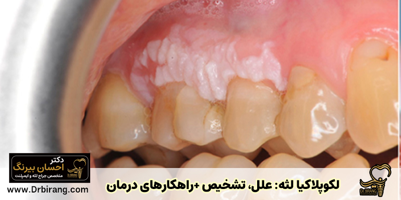 White spots on the gums (gum leukoplakia) causes + treatment methods - Dr. Ehsan Birang