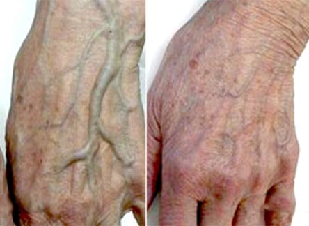 Varicose veins on the back of the hand - the fastest way to treat varicose veins of the hand Iranian superspeciality center