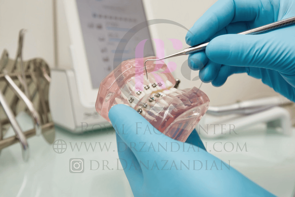 Orthodontic bracket - metal bracket or ceramic bracket? Which one should we choose?