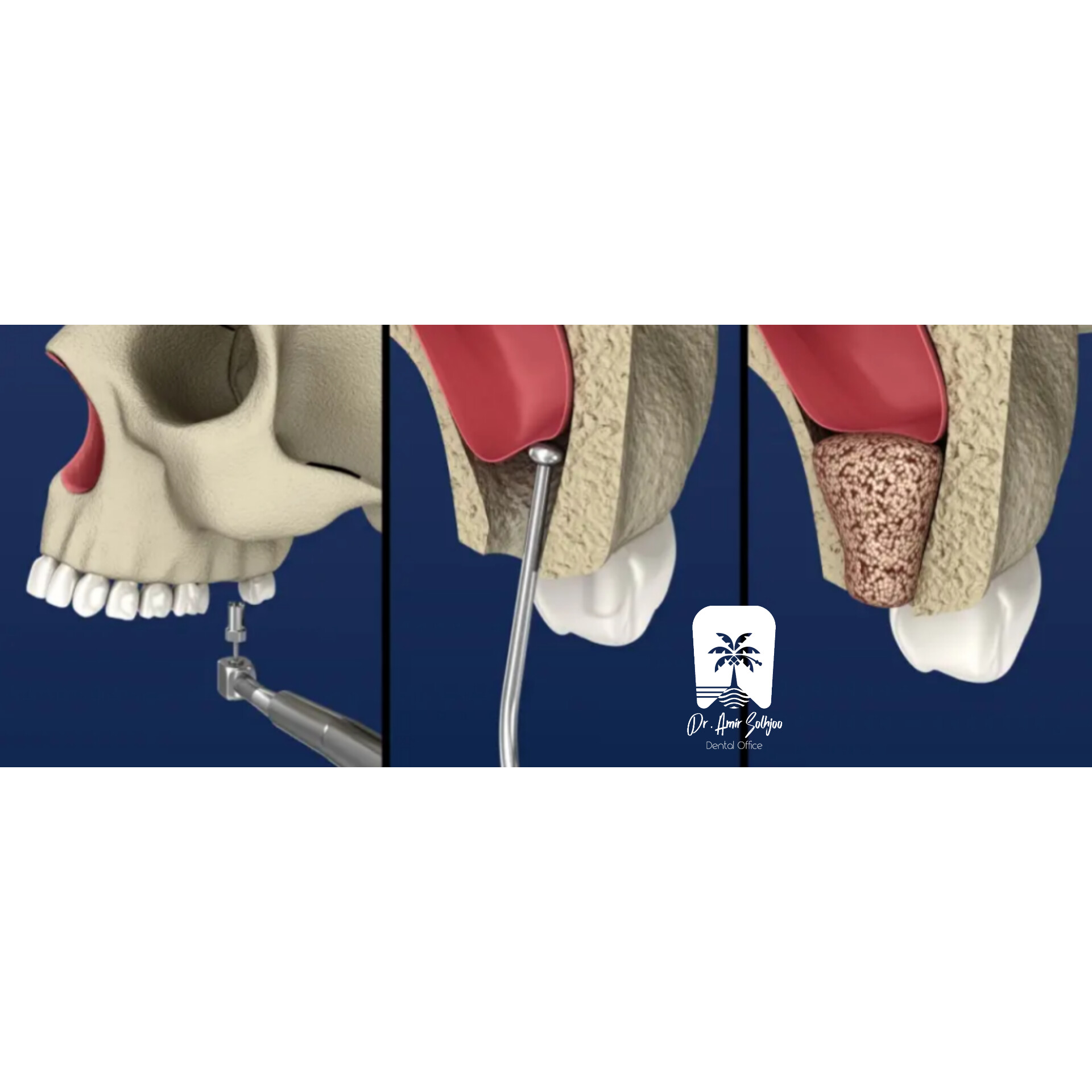 جراحی بسته سینوس هزینه + شرایط اقساط