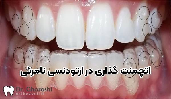 چسبندگی در ارتودنسی نامرئی چیست؟