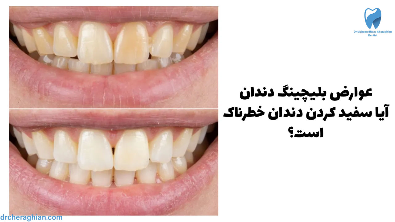 9 آثار جانبية لتبييض الأسنان – هل تبييض الأسنان خطير؟
