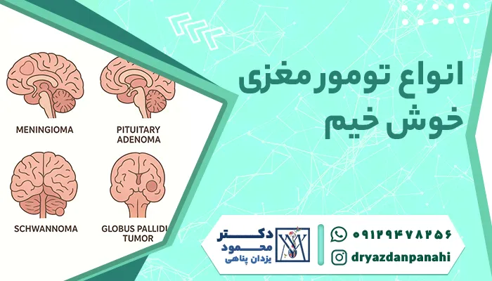 Types of benign brain tumor Is a benign brain tumor fatal?