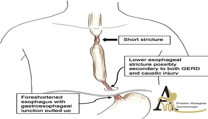Benign esophageal stricture - gastroenterology specialist in Mashhad Dr. Mehdi Afzal Aghaei