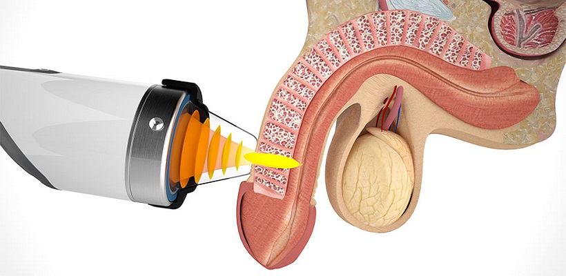 شاک ویو تراپی برای رفع مشکلات جنسی - مرکز اورولوژی جهانشهر