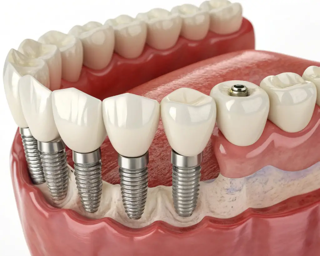 ایمپلنت دندان یا لمینت؟ کدام یک بهتر است؟