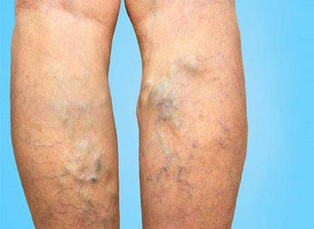 Spider veins - skin telangiectasia - spider varicose veins - Iranian superspeciality center