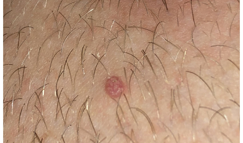 Laser genital warts in the clinic - Jahanshahr Urology Center