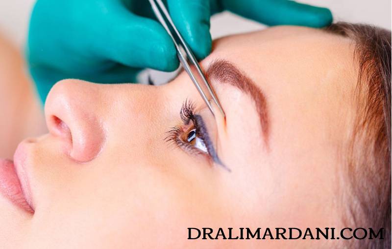 Everything about eyelid surgery (blepharoplasty) - Dr. Hossein Alimardani