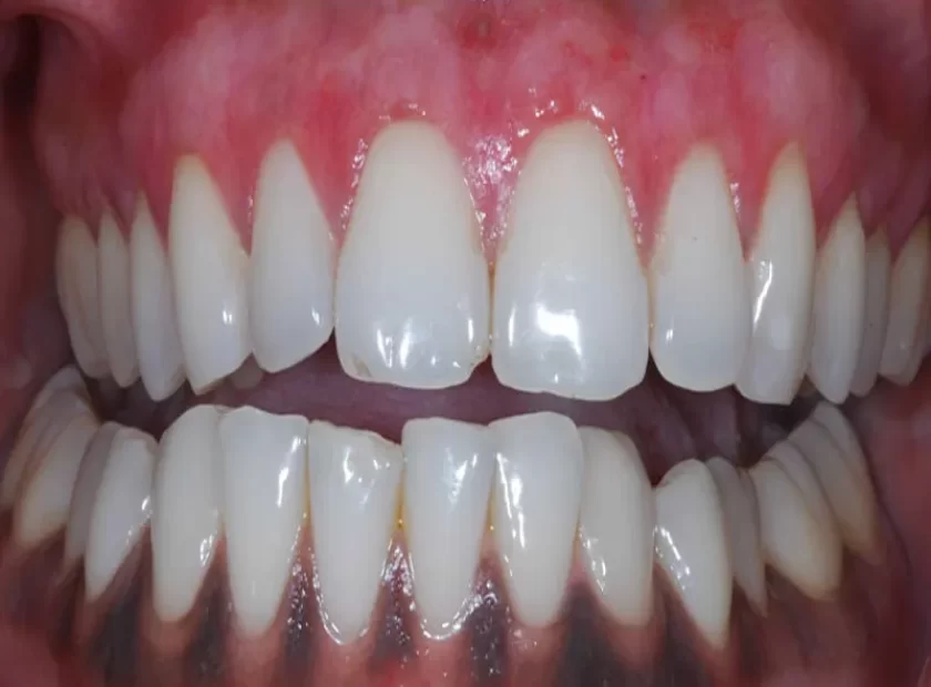 سیاه شدن لثه بعد از کاشت - دکتر بهمن پوراقدم