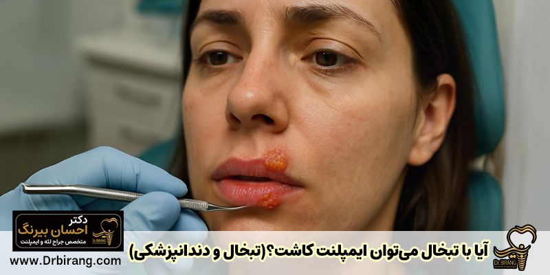 آیا می توان ایمپلنت را با تبخال کاشت کرد؟ (تبخال و دندانپزشکی) - دکتر احسان بیرنگ