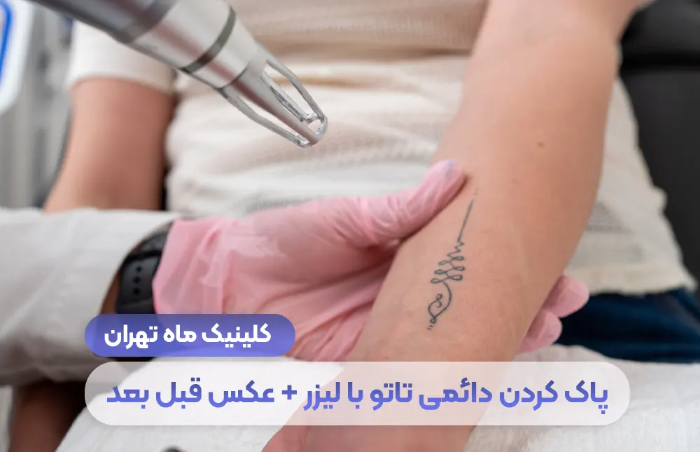 صورة قبل وبعد وشم الحواجب والجسم بالليزر + السعر والتكلفة - Mah Clinic طهران