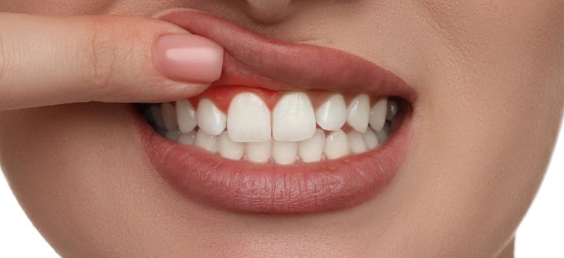 Allergy to metal and titanium implants + treatment Amytis