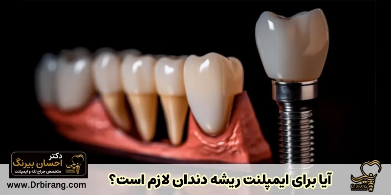 Is it necessary for tooth root implant? (implant on tooth root) - Dr. Ehsan Birang