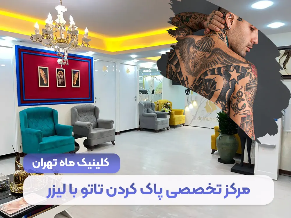 مركز متخصص لإزالة الوشم بالليزر في طهران + السعر اليومي - العيادة في طهران
