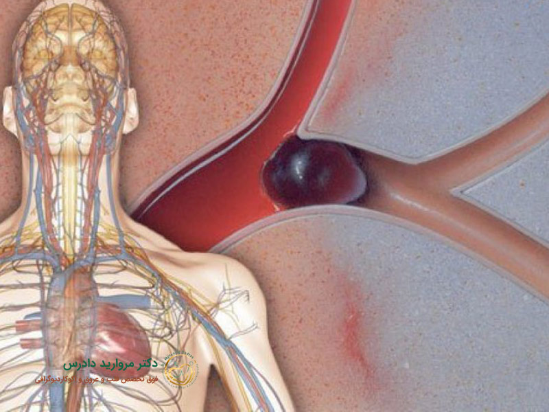 ما هي متلازمة الشريان التاجي الحادة؟ الأعراض والأسباب وطرق العلاج - د. مارفاريد دادريس