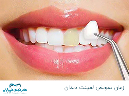 عمر صفائح الأسنان - متى يتم استبدال صفائح الأسنان